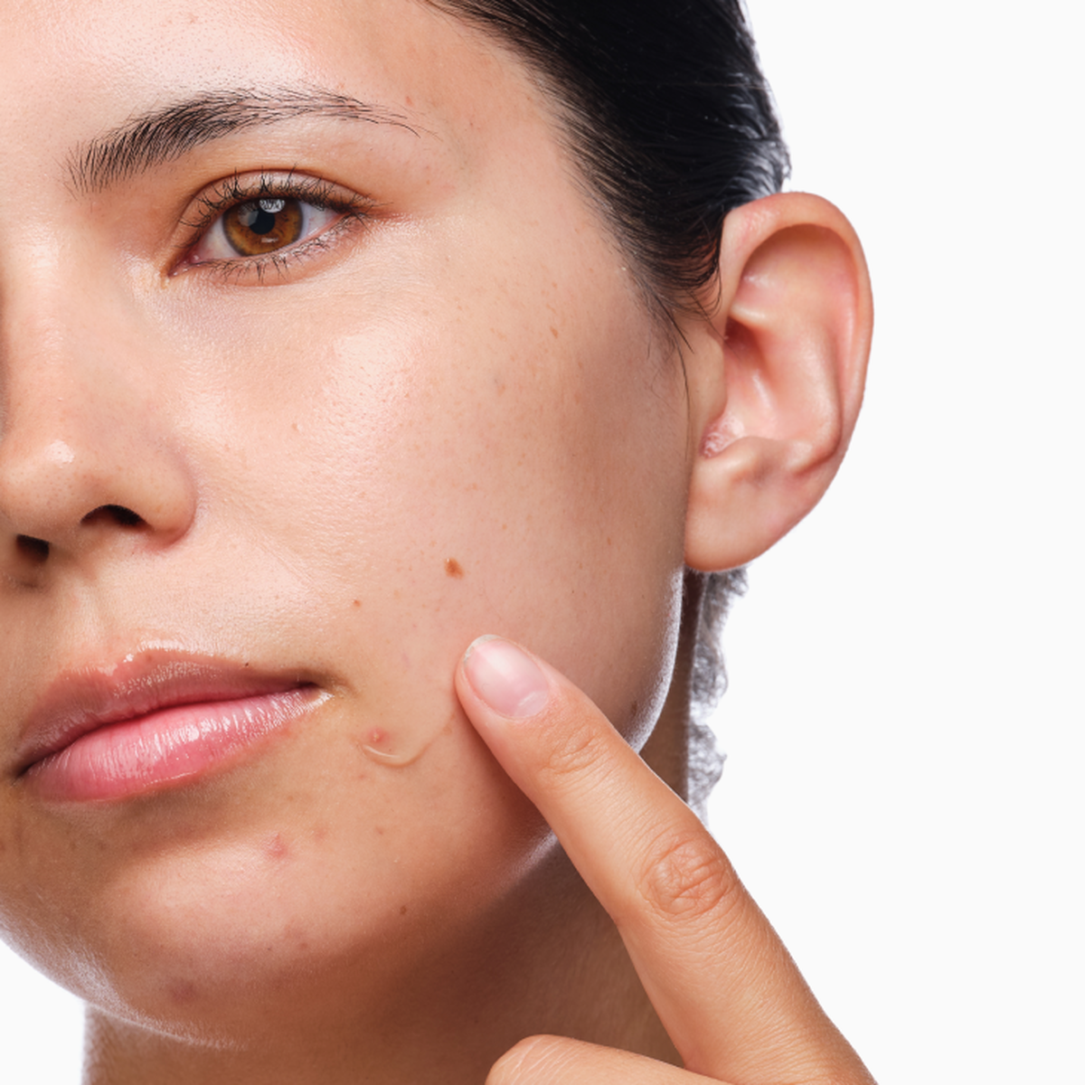 the-acne-set-k6 rdn-the-acne-set-application.png