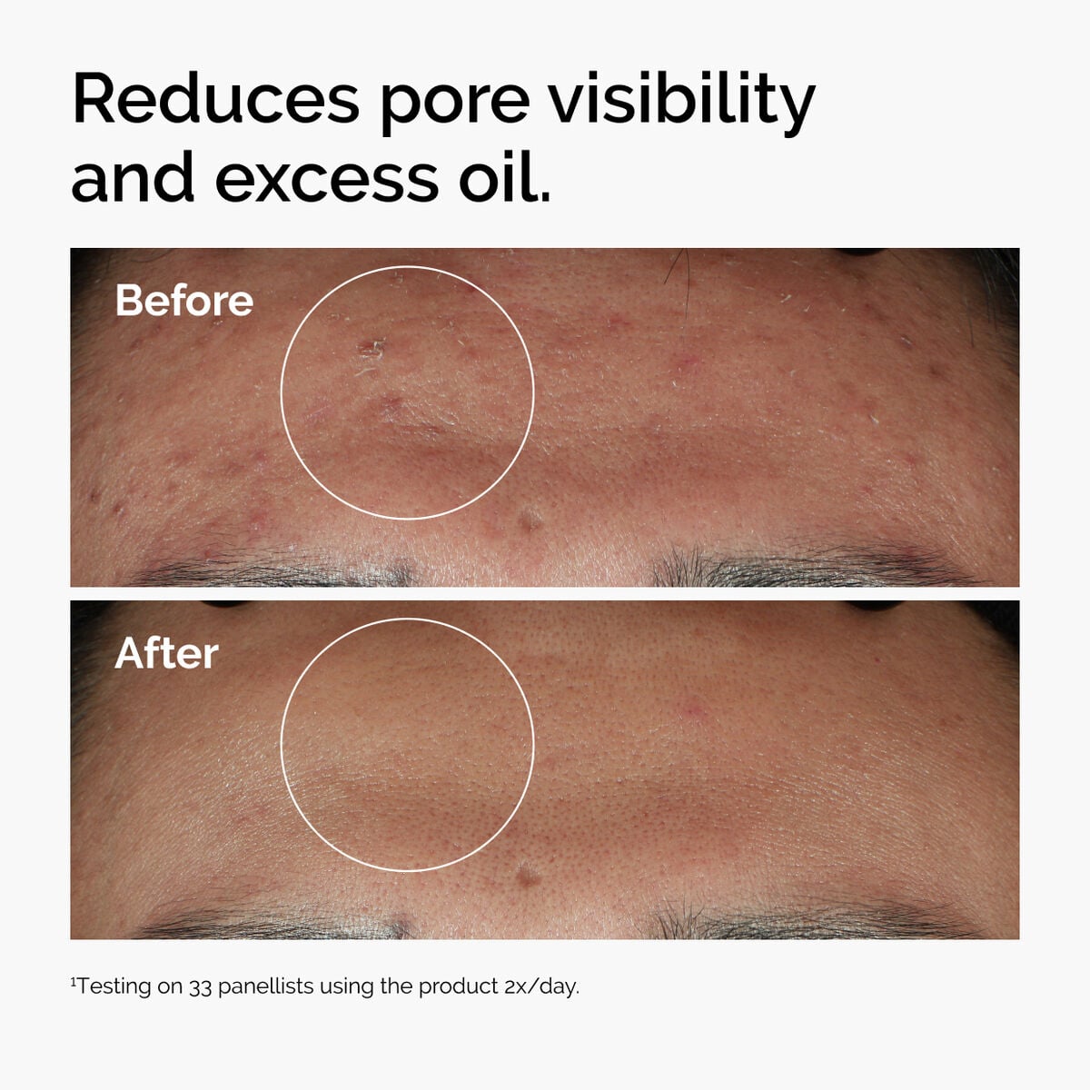 niacinamide-10-zinc-1-m7 ord-niacinamide-zinc-blemish-serum-before-after-pores.jpg
