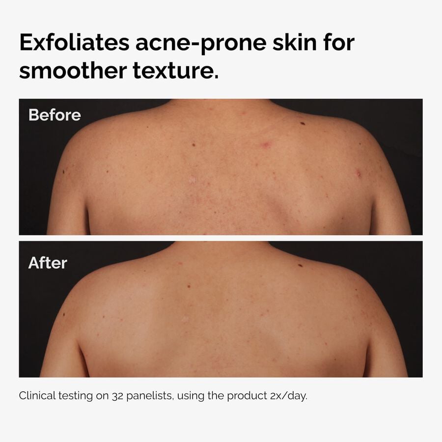 the-body-care-collection-z1 ord-salicylic-acid-body-serum-before-after-graphic-NA.jpg
